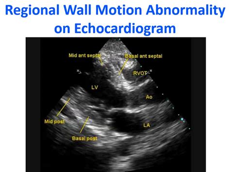 wall motion abnormalities echo